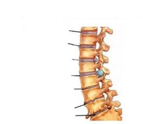 Osteokondrosiaren sintomak
