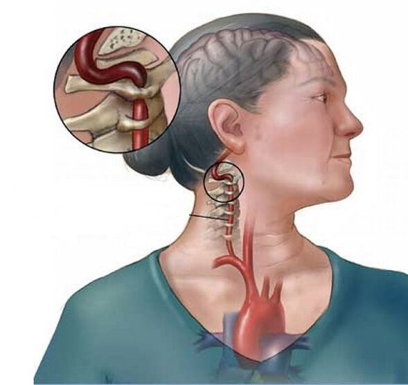 orno-arteriaren sindromea zerbikal-osteokondrosiarekin