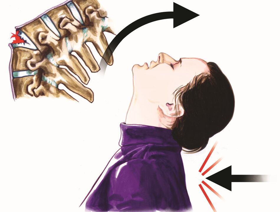 bizkarrezurreko kaltea lepoko minaren kausa gisa