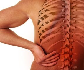 bizkarreko mina lumbar osteokondrosiarekin