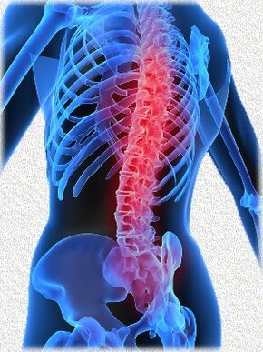 osteokondrosia eta bere tratamendu metodoak